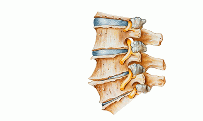 CHỮA THOÁI HÓA ĐỐT SỐNG CỔ THẾ NÀO MỚI HIỆU QUẢ
